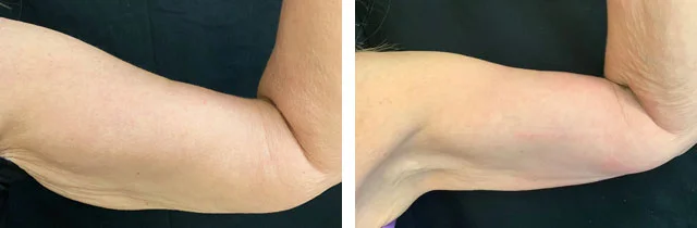dr-levine-emsculpt-treatment.jpg