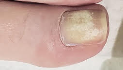 institute-beauture-toenail-procedures-before.jpg