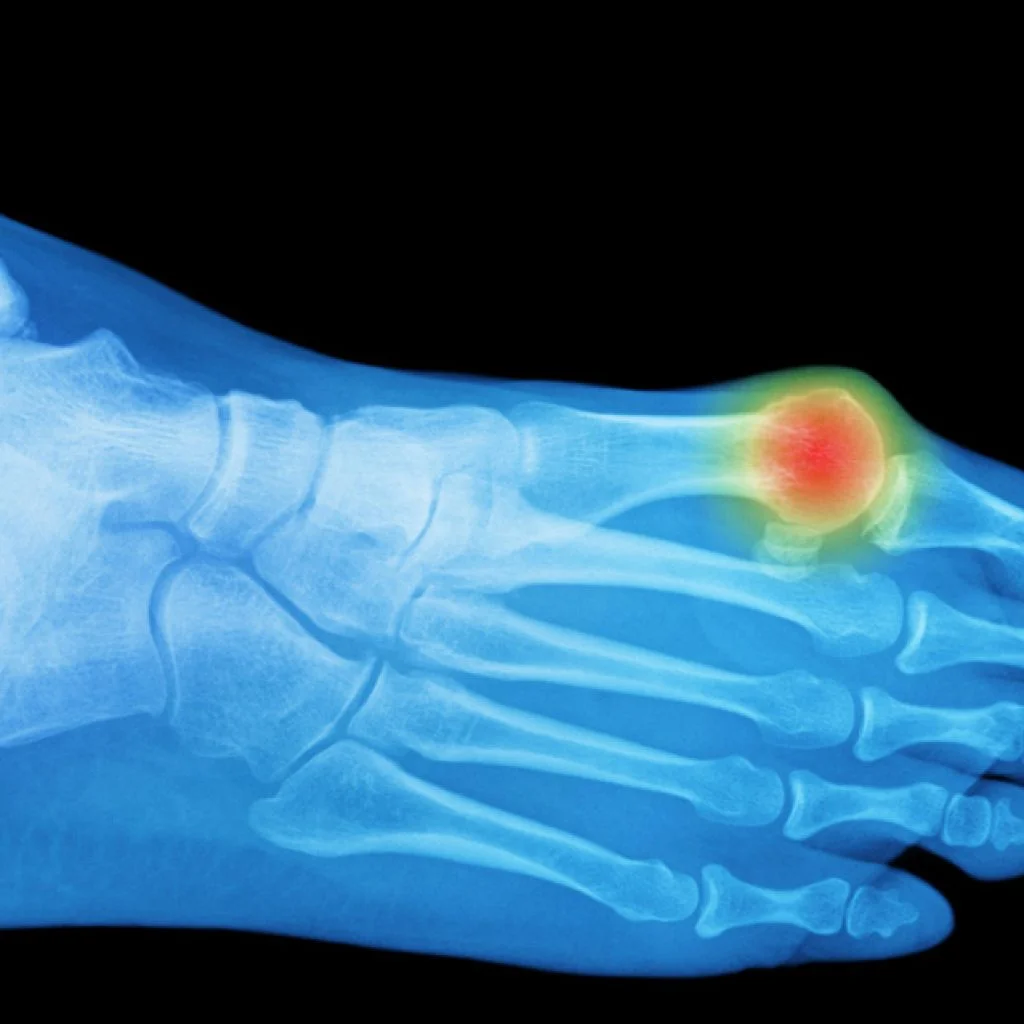 ib_services_bunion_deformity_fi-1024x1024.jpg