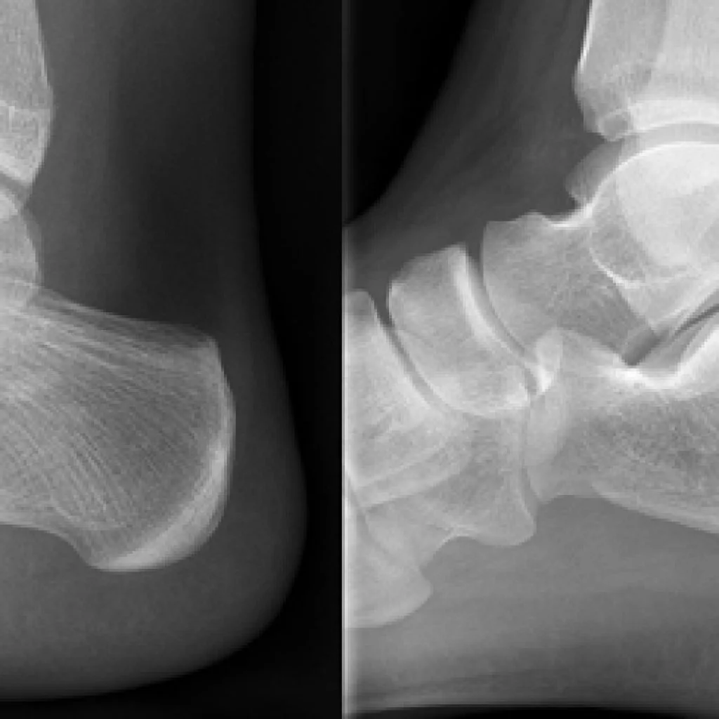 tarsal-coalition-surgery-1024x1024.jpg