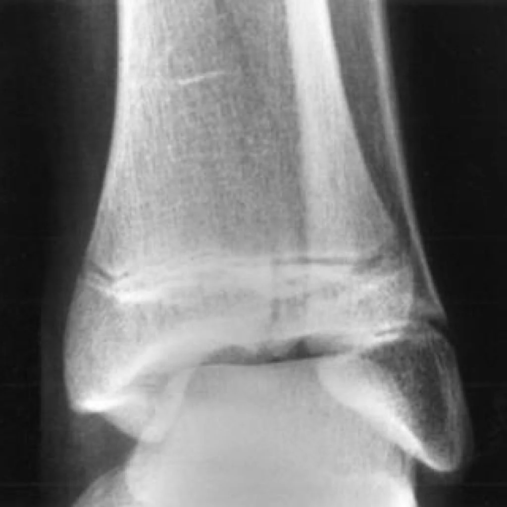 ankle-fracture-1024x1024.jpg
