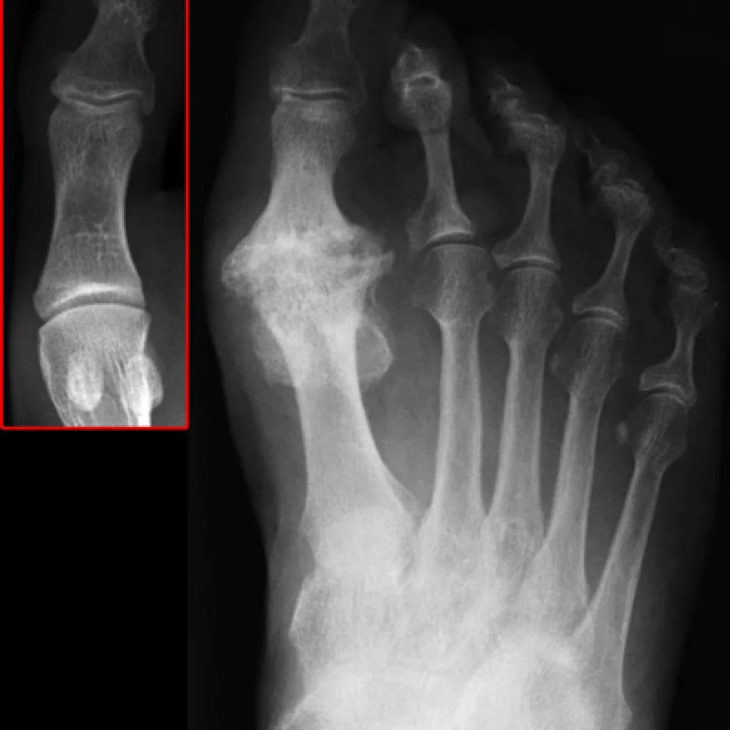 big-toe-joint-arthritis-1024x1024.jpg