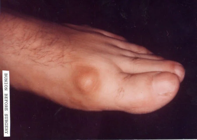 bunion_surgery_before-after-nyc.jpg