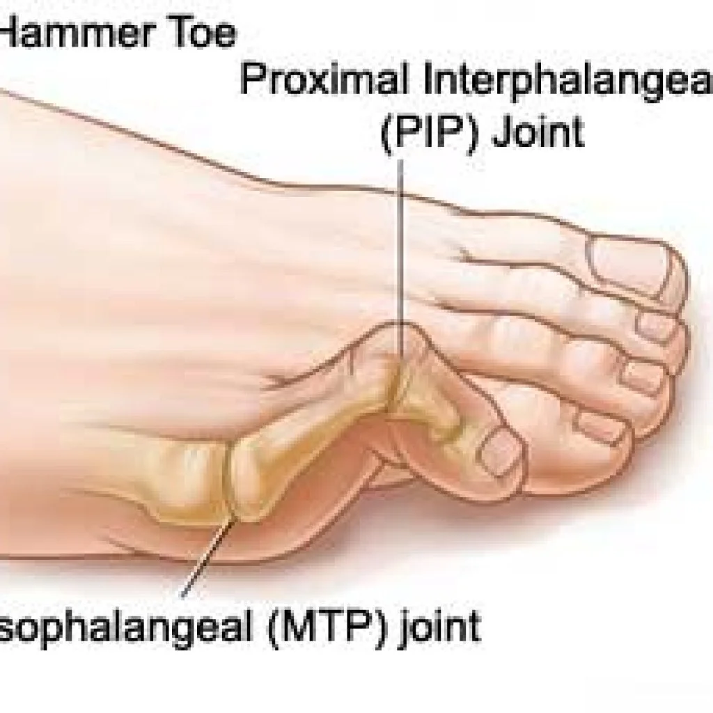 hammertoe-1024x1024.jpg