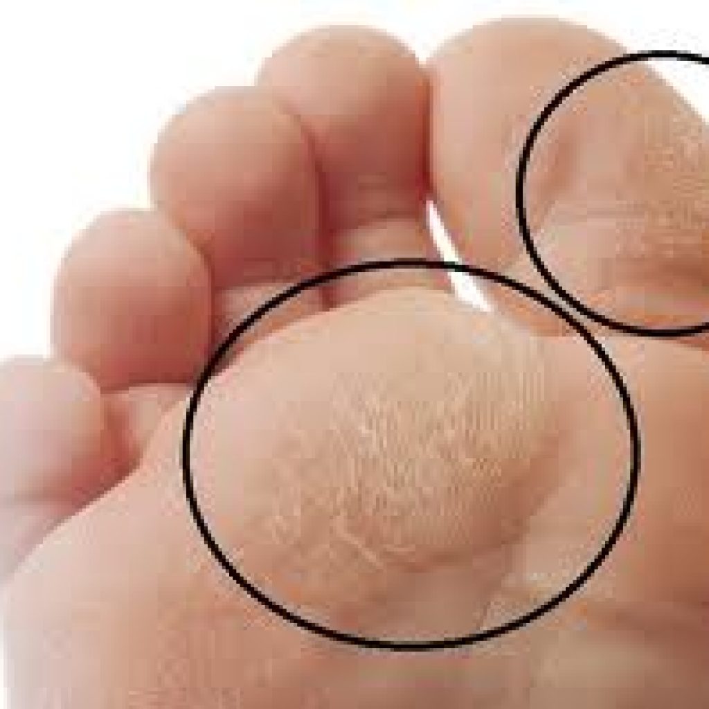 calluses-on-foot-1024x1024.jpeg