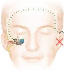 Single Sided Deafness