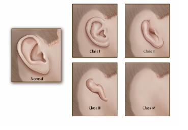 Microtia Awareness Day