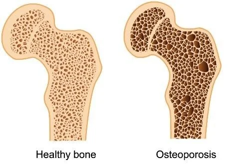 Osteoporosis and the Benefit of Pilates