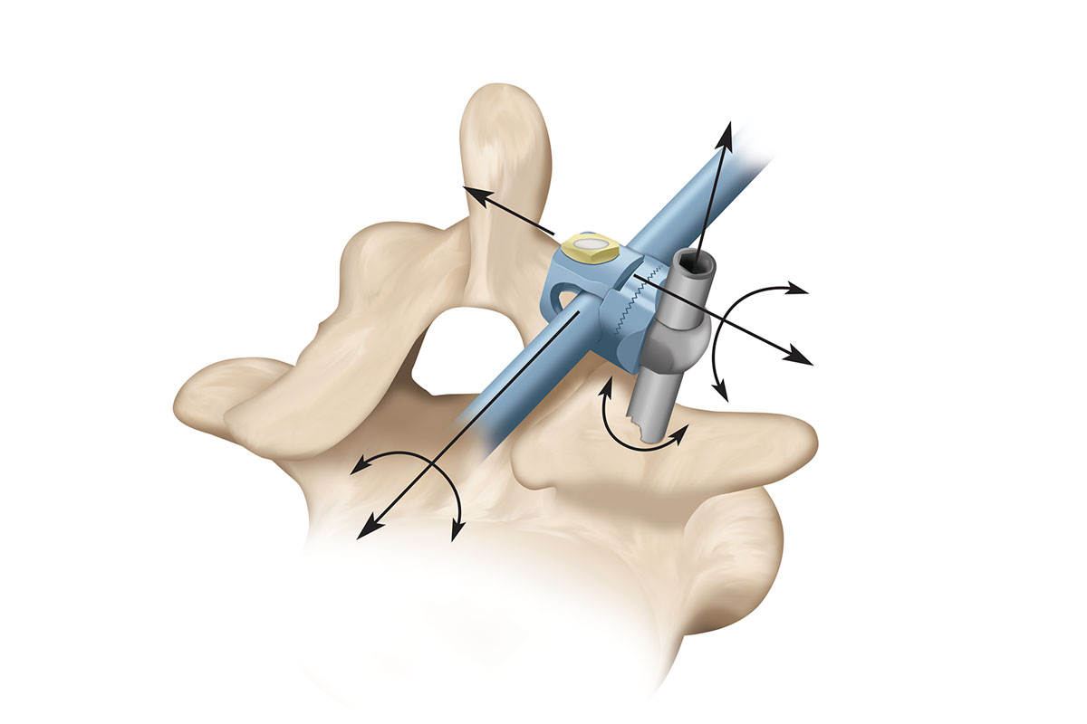 Medtronic Sofamor Danek Illustration