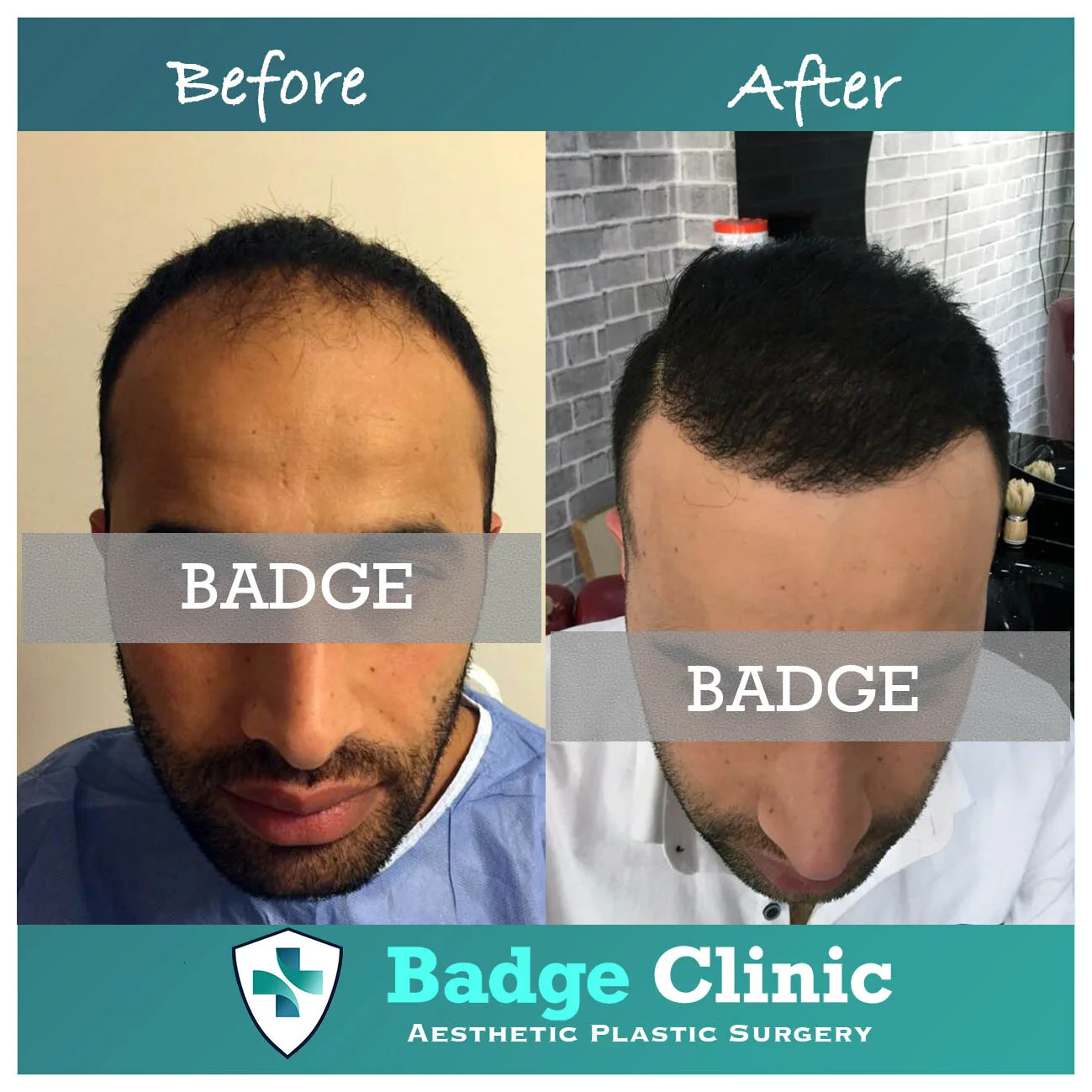 زراعة شعر الوجه Badge Clinic
