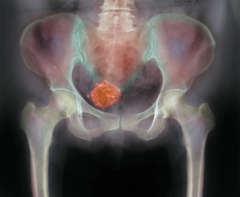 Fibroids and the MRI.jpg