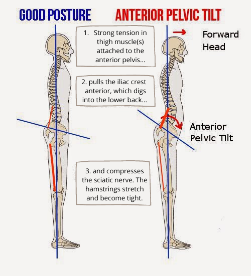 Hip Tight Legs Causing Back Pain Tight Lower Back Are Tight Hip