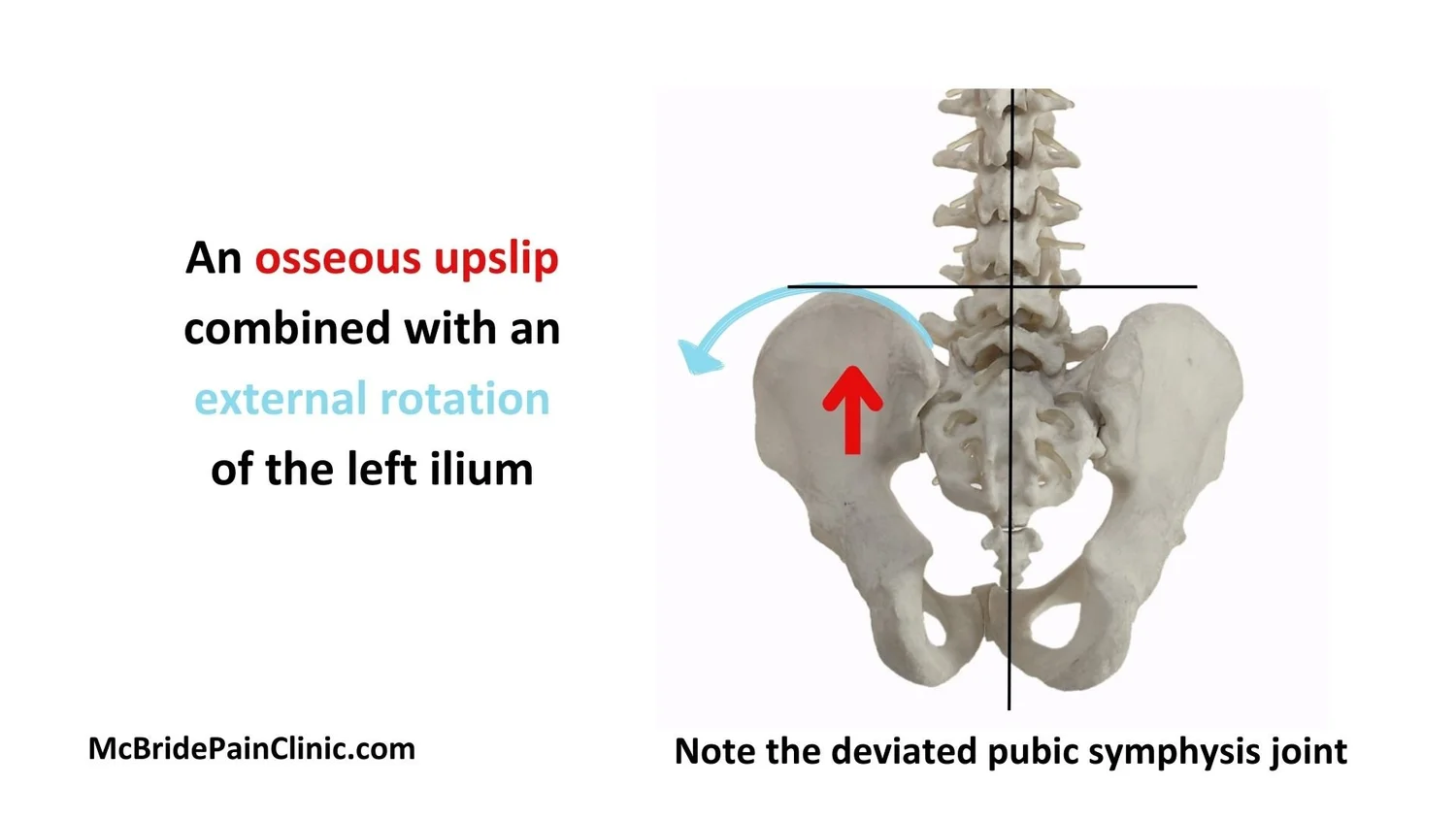 Pelvis Rotations and Upslips — McBride Pain Clinic