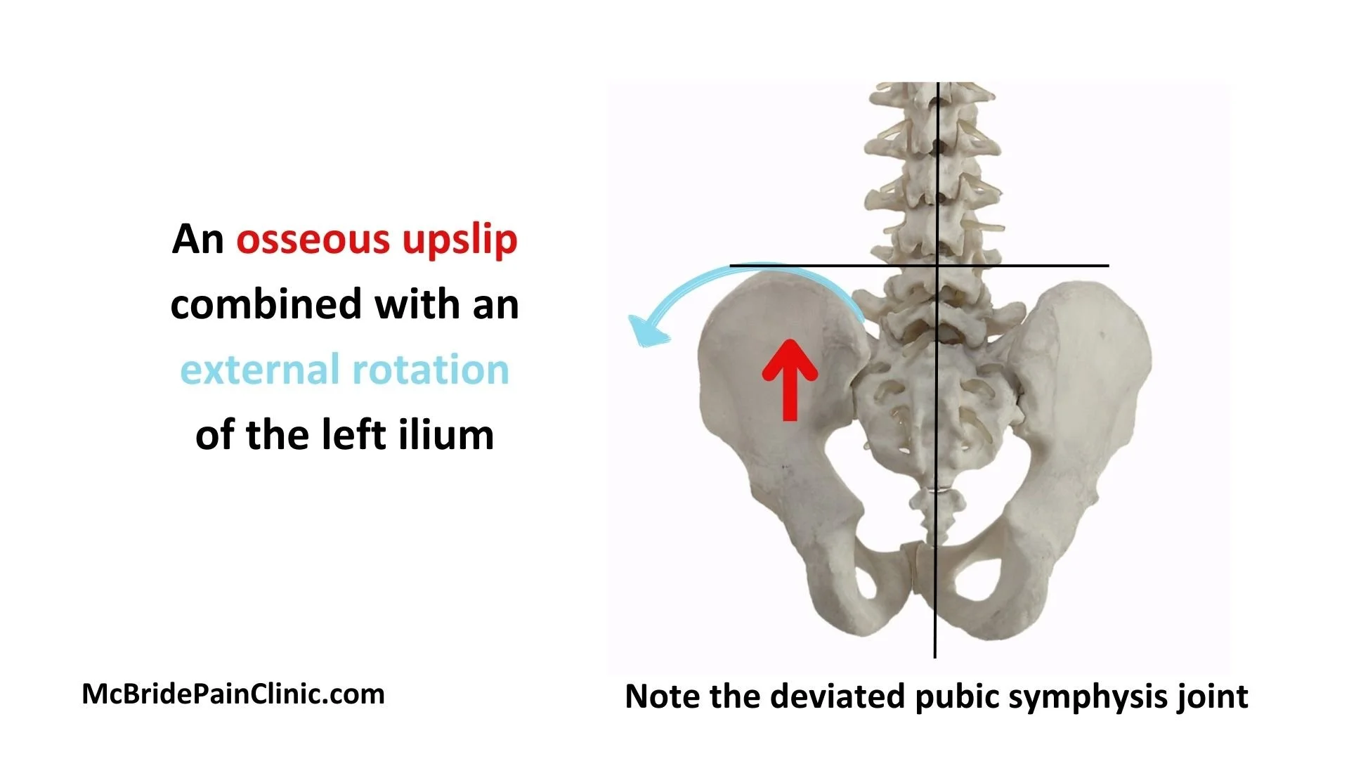 Pelvis Rotations and Upslips — McBride Pain Clinic