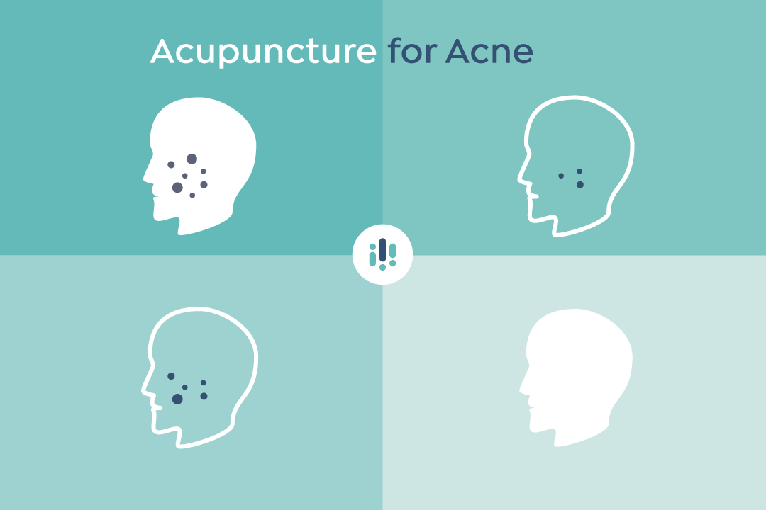 Acupuncture for Acne