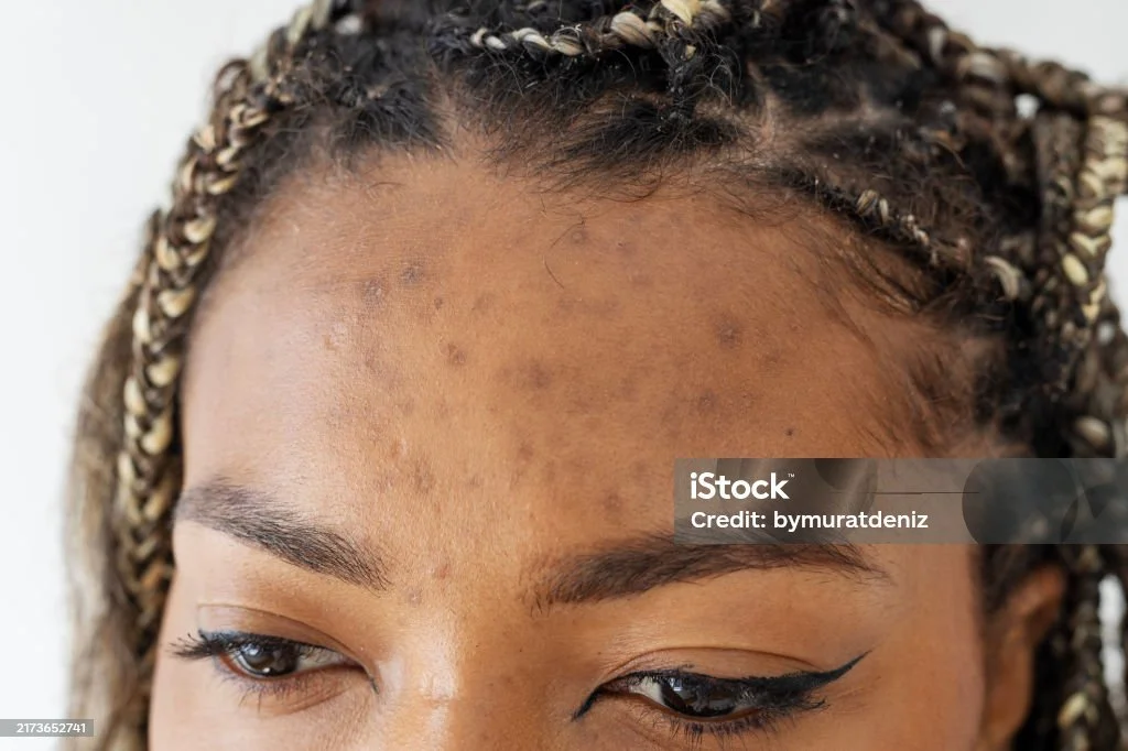 Summer Acne Flare-Ups: A Guide for Women of Color