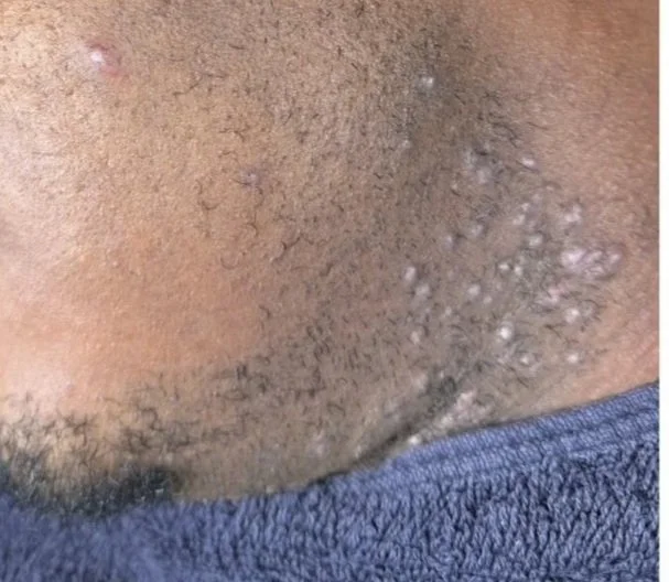 Ingrown Hairs on Dark Skin: Prevention &amp; Treatment