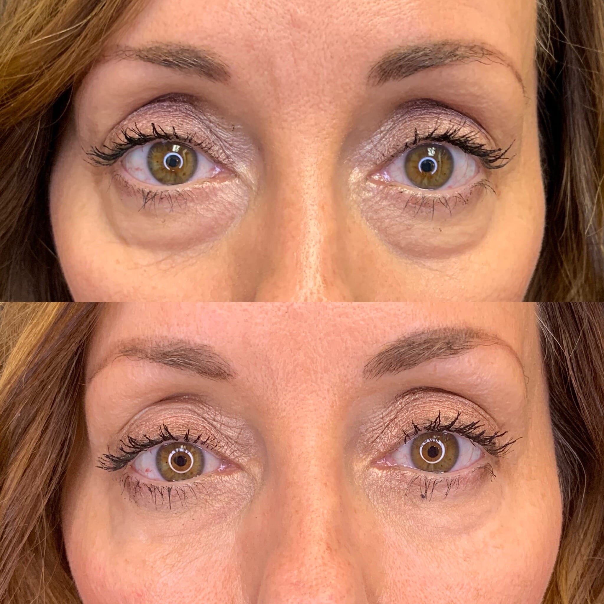 UnderEye Fillers  Gabriela Casabona MD  Ocean Clinic