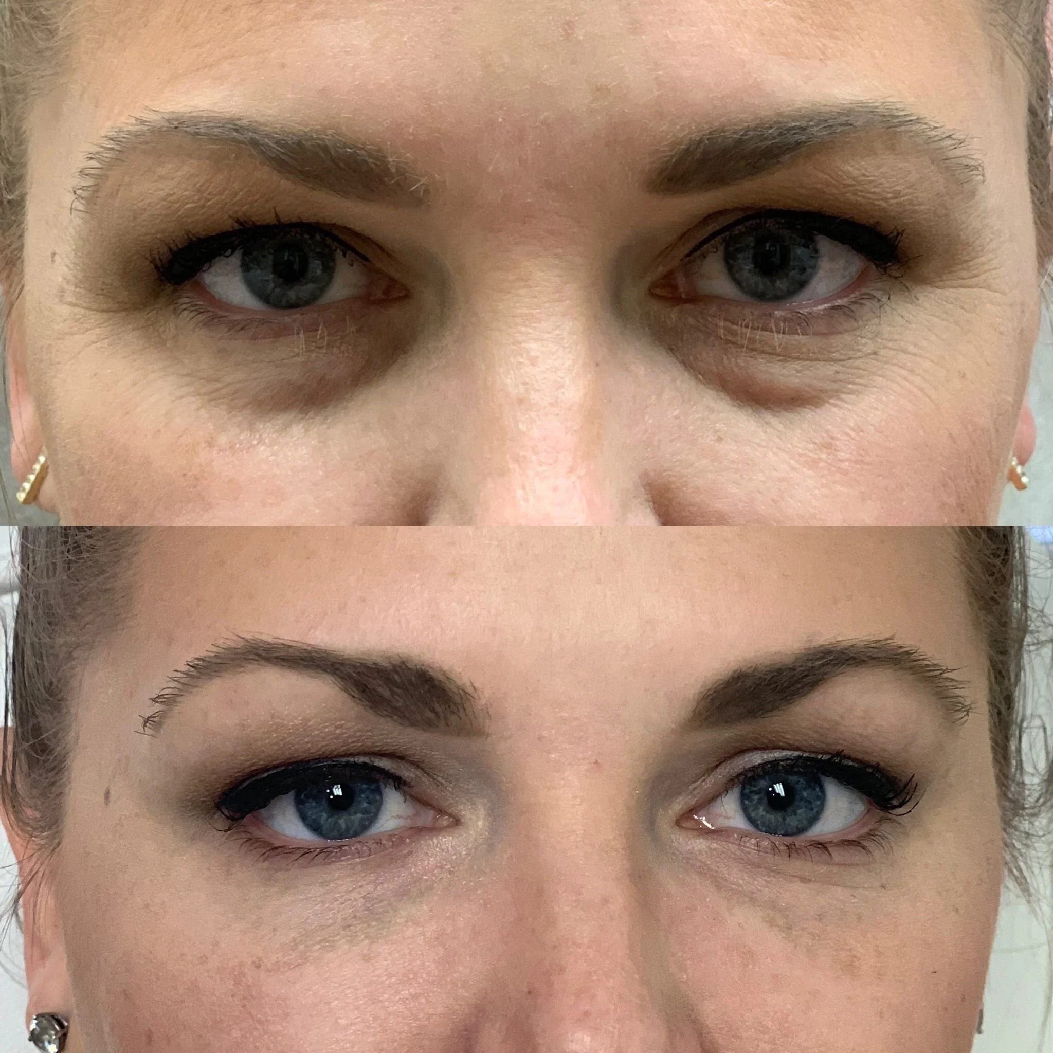 Tear Trough Treatment — Laserase Newcastle