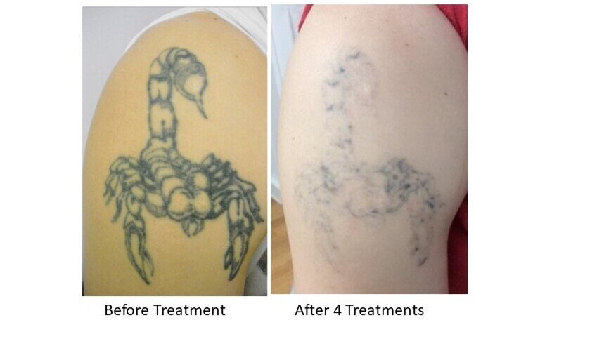 Tattoo Removal — Laserase Newcastle