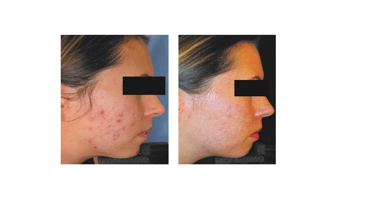 acne girl before and after.jpg