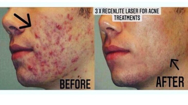 before+and+after+boy+2+acne.jpg