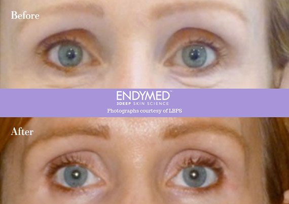 endybleph-before-after-image.jpg