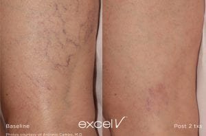 leg veins before and after website.jpg