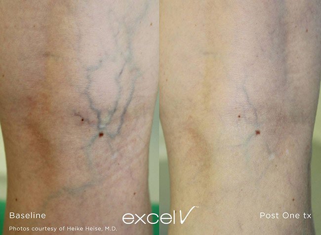 leg veins before and after 2 website.jpg