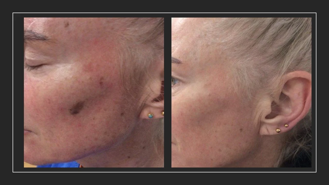 facial pigmentation.jpg