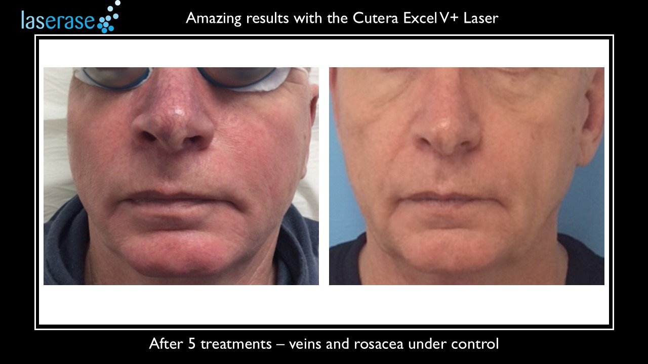 face 2025 after 5 treatments.jpg