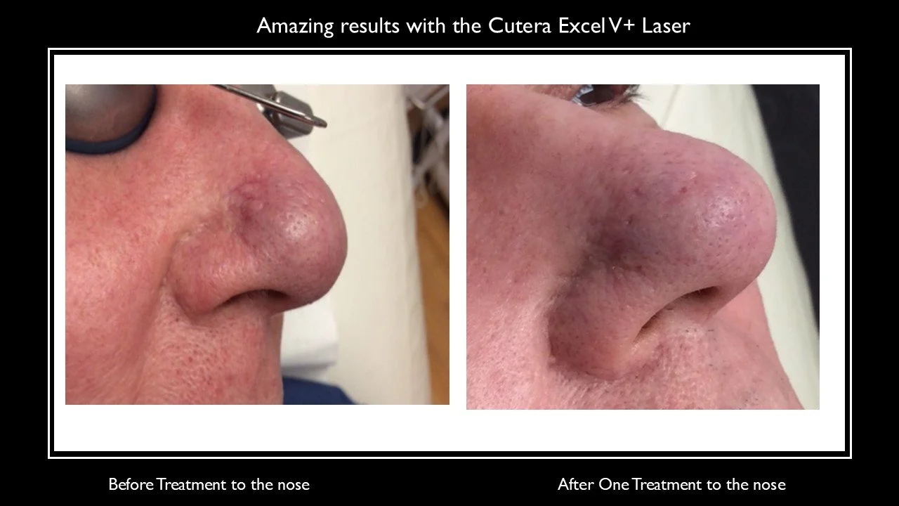 face advert nose.jpg