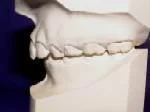 Class II A Malocclusion where the upper teeth stick out past the lower teeth. This is also called an “overbite.”