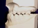 Class III A Malocclusion where the lower teeth stick out past the upper teeth. This is also called an “underbite.”