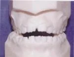 Openbite Anterior opening between upper and lower teeth.