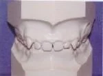 Overbite Vertical overlapping of the upper teeth over the lower.