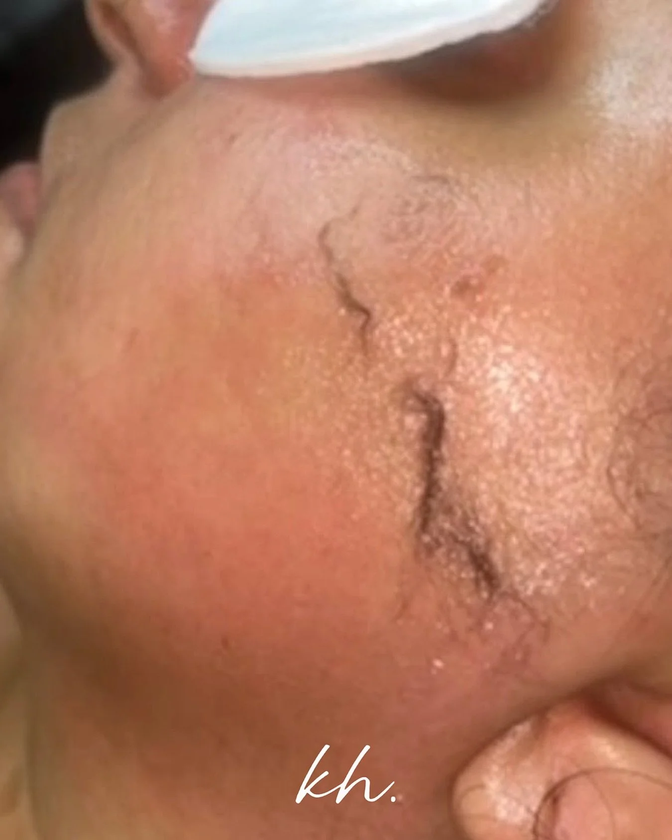 ☀️ Summer is the PERFECT time for Dermaplaning! ☀️

Did you know the summer sun highlights every little detail on your skin&hellip; including that peach fuzz you probably don&rsquo;t even realise is there? 👀

Dermaplaning gently removes dead skin ce