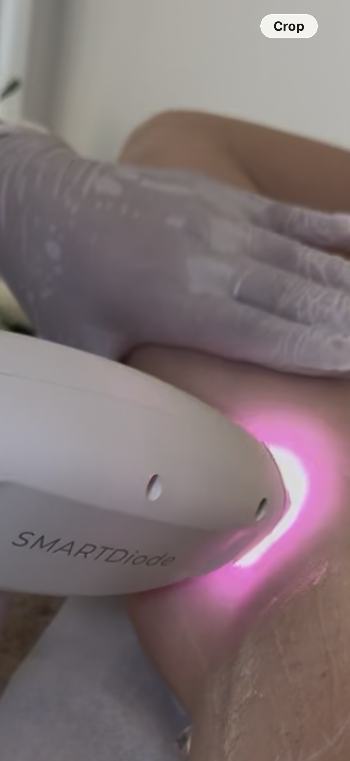 Standard Bikini Line Laser