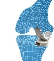 partial+knee+replacement.jpg
