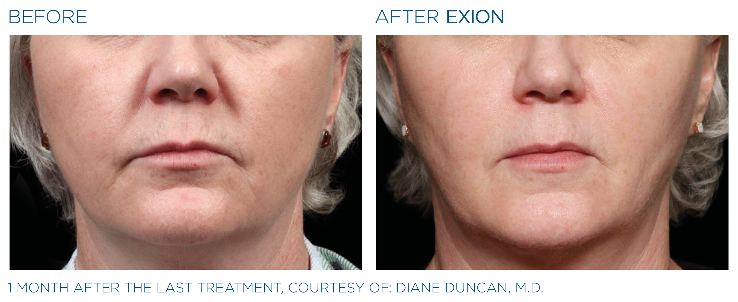 Exion® Face — Dr. Hong Med Spa - Newton, MA