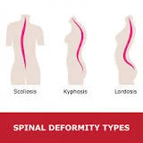LORDOSIS