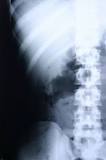 STEOPOROSIS / COMPRESSION FRACTURE