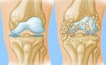 KNEE OSTEOARTHRITIS