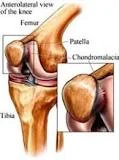 CHONDROMALACIA PATELLA