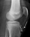 OSGOOD-SCHLATTER DISEASE