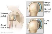 SLAP Tear