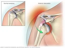 Dislocated Shoulder