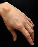 GANGLION CYST
