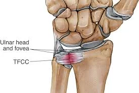 TRIANGULAR FIBROCARTILAGE COMPLEX TEAR