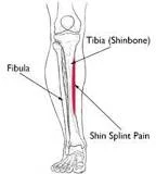 SHIN SPLINTS
